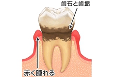 軽度の歯周炎