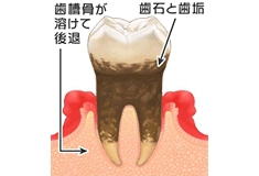 中等度の歯周炎