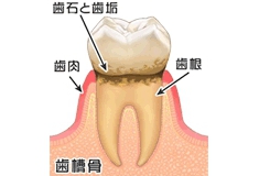 歯肉炎