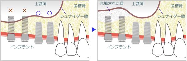 サイナスリフト（上顎洞挙上術）