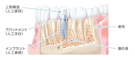 implant